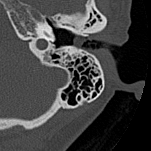 File:Cholesteatoma of the external ear (Radiopaedia 16540-16225 Axial bone window 24).jpg