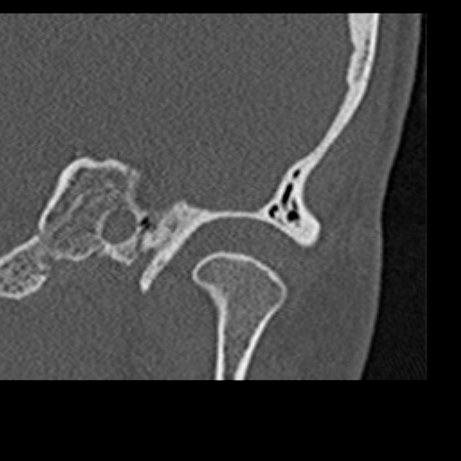 File:Cholesteatoma of the external ear (Radiopaedia 16540-16225 Coronal bone window 1).jpg