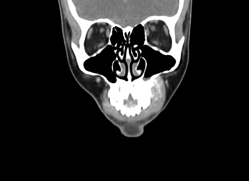 File:Chondroblastic osteosarcoma (Radiopaedia 67363-76741 D 24).jpg