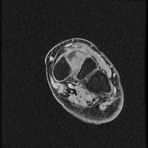 File:Chondroblastoma - midfoot (Radiopaedia 64831-73765 F 13).jpg