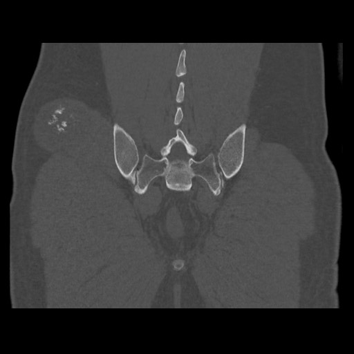 Chondrosarcoma of iliac wing (Radiopaedia 63861-72599 Coronal bone window 94).jpg