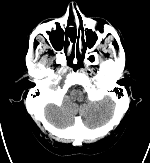 File:Chondrosarcoma of skull base- grade II (Radiopaedia 40948-43653 Axial non-contrast 4).png