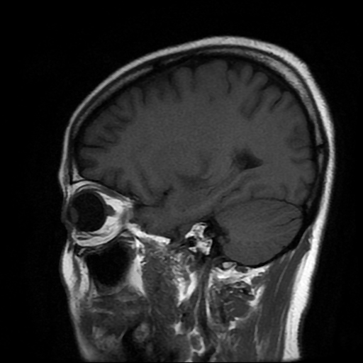 File:Chordoid glioma of third ventricle (Radiopaedia 91612-109340 Sagittal T1 19).jpg
