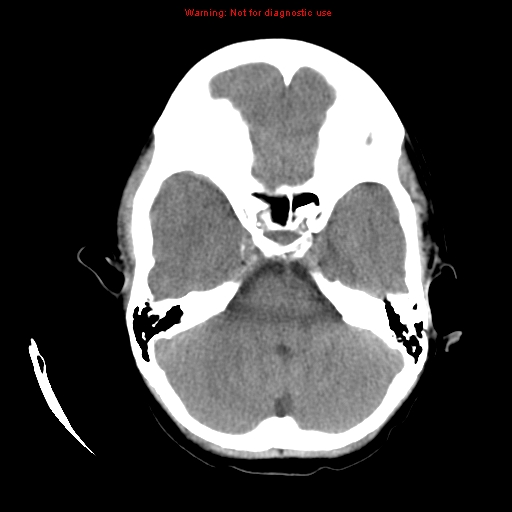 File:Choroid plexus carcinoma - recurrent (Radiopaedia 8330-9168 Axial non-contrast 6).jpg