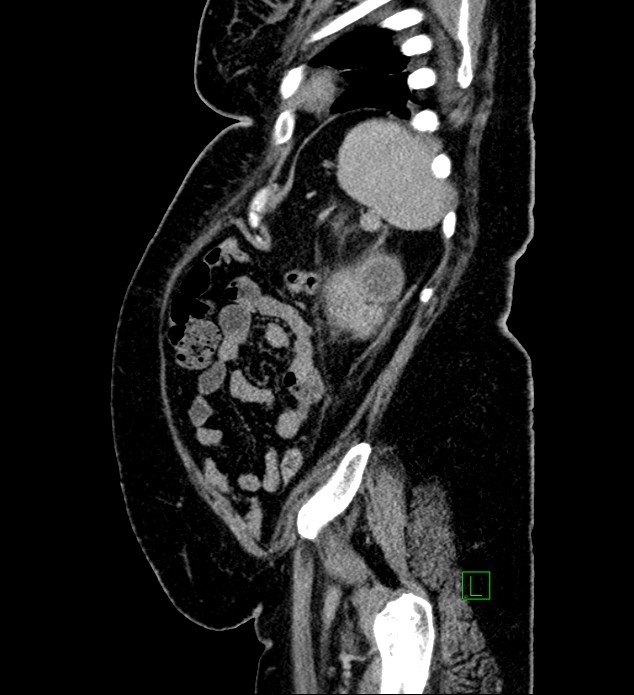 Chromophobe renal cell carcinoma (Radiopaedia 84239-99519 G 24).jpg