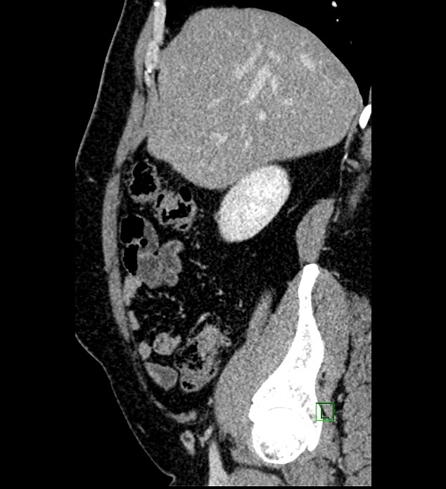 Chromophobe renal cell carcinoma (Radiopaedia 84286-99573 I 142).jpg