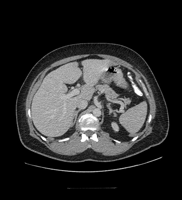 Chromophobe renal cell carcinoma (Radiopaedia 84337-99644 C 38).jpg
