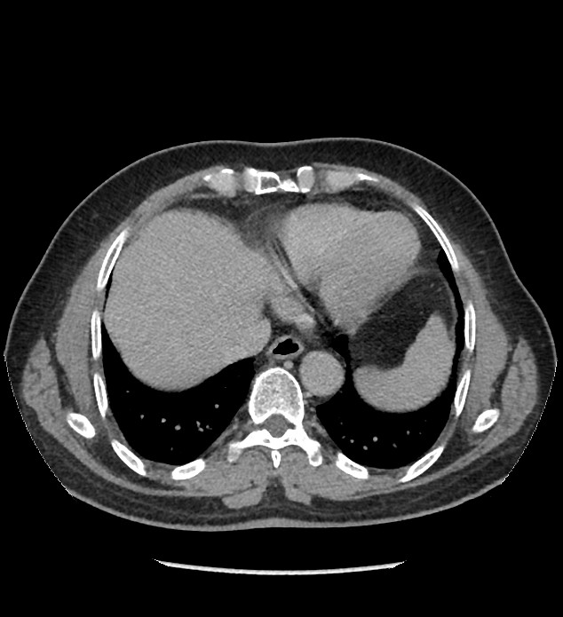 Chromophobe renal cell carcinoma (Radiopaedia 86879-103083 D 8).jpg