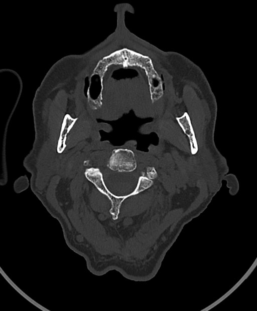 Chronic bilateral subdural hygroma (Radiopaedia 85801-101623 Axial bone window 126).jpg