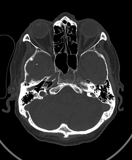 Chronic bilateral subdural hygroma (Radiopaedia 85801-101623 Axial bone window 94).jpg