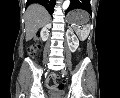 Chronic contained rupture of abdominal aortic aneurysm with extensive erosion of the vertebral bodies (Radiopaedia 55450-61901 D 52).jpg