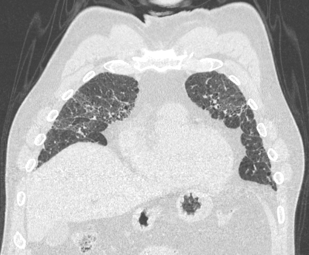 File:Chronic hypersensitivity pneumonitis (Radiopaedia 48107-52922 Coronal lung window 8).png