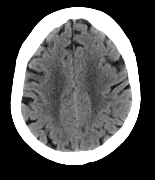 File:Chronic hypertensive encephalopathy (Radiopaedia 39993-42485 Axial non-contrast 24).png