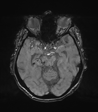 Chronic hypertensive encephalopathy (Radiopaedia 72844-83495 Axial SWI magnitude 31).png