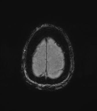 Chronic hypertensive encephalopathy (Radiopaedia 72844-83495 Axial SWI magnitude 78).png
