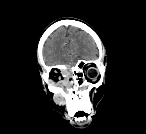 Chronic invasive fungal sinusitis with intraorbital and intracranial extension (Radiopaedia 56387-63046 C 89).jpg