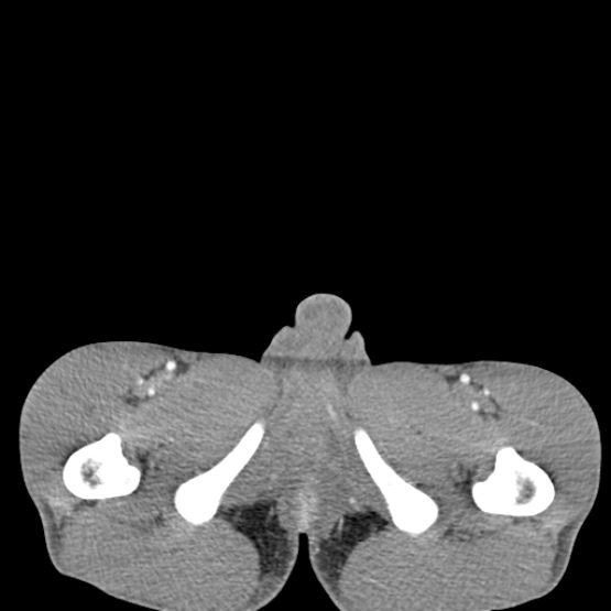 Chronic large bowel pseudo-obstruction (Radiopaedia 43181-46492 A 172).jpg