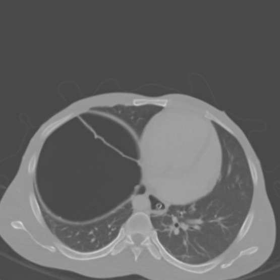 Chronic large bowel pseudo-obstruction (Radiopaedia 43181-46492 Axial bone window 24).jpg