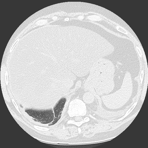 File:Chronic lung allograft dysfunction - restrictive form (Radiopaedia 60595-68316 Axial lung window 65).jpg