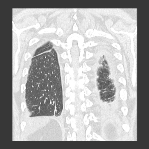 Chronic lung allograft dysfunction - restrictive form (Radiopaedia 60595-68316 Coronal lung window 79).jpg