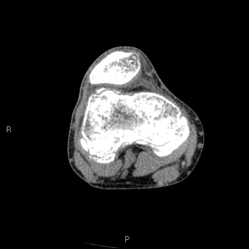 Chronic osteomyelitis (with Brodie abscess) (Radiopaedia 76405-88111 A 143).jpg