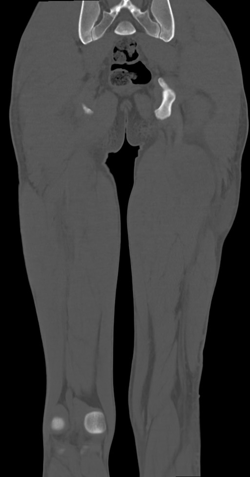Chronic osteomyelitis (with sequestrum) (Radiopaedia 74813-85822 Coronal non-contrast 43).jpg
