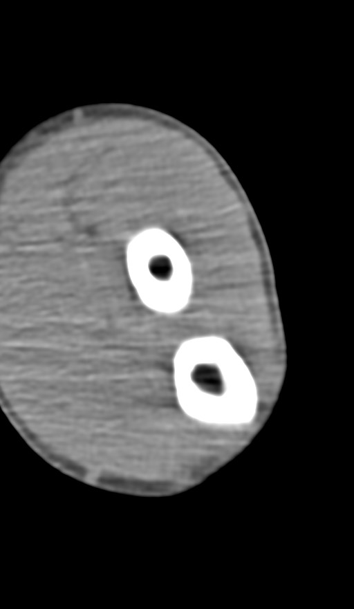 Chronic osteomyelitis of the distal humerus (Radiopaedia 78351-90971 Axial non-contrast 114).jpg
