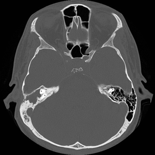 File:Chronic otomastoiditis (Radiopaedia 27138-27309 Axial bone window 45).jpg