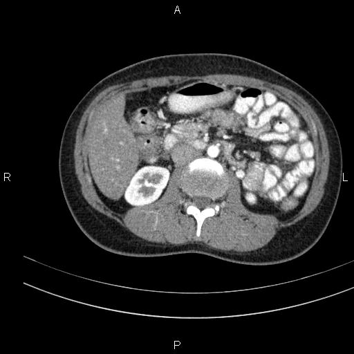Chronic pancreatitis (Radiopaedia 64576-73450 B 74).jpg