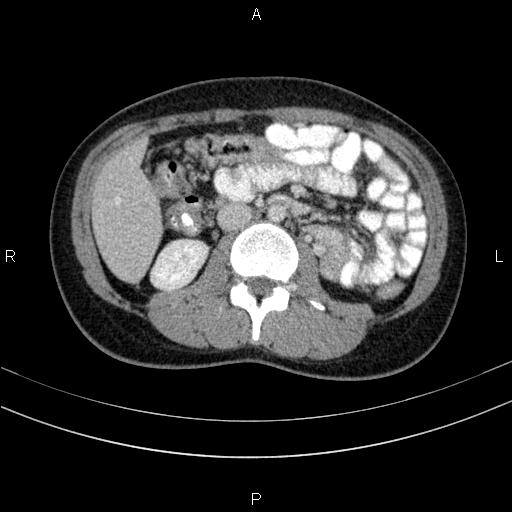 File:Chronic pancreatitis (Radiopaedia 64576-73450 C 78).jpg
