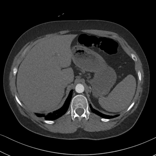 File:Chronic pulmonary embolus (Radiopaedia 39129-41341 Axial C+ CTPA 96).png