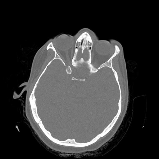 Chronic sinusitis with intra-sinus calcification (Radiopaedia 63919-72668 Axial bone window 5).jpg