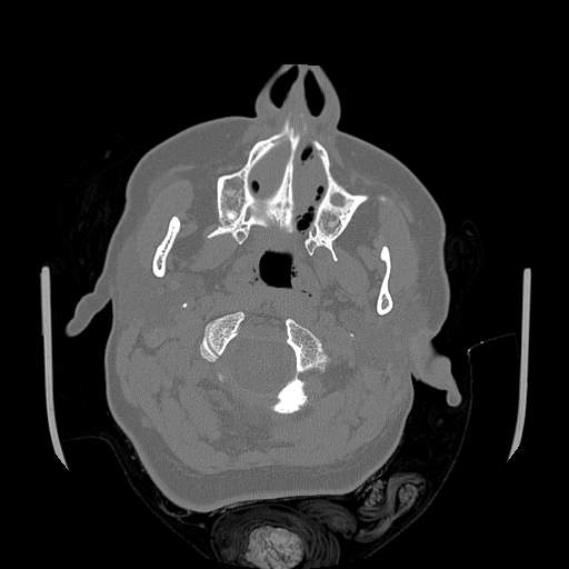 File:Chronic sinusitis with intra-sinus calcification (Radiopaedia 63919-72668 Axial bone window 76).jpg