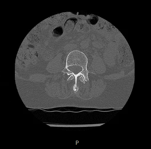 Chronic spinal hematoma with cauda equina syndrome (Radiopaedia 75745-88197 Axial bone window 23).png