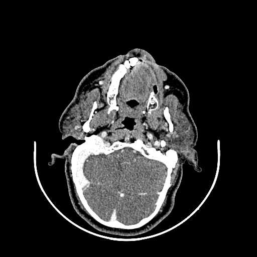 File:Chronic submandibular abscess (Radiopaedia 21738-21718 A 5).jpg