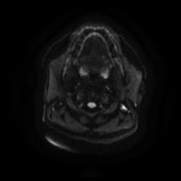 Chronic submandibular sialadenitis (Radiopaedia 61852-69885 Axial DWI 11).jpg