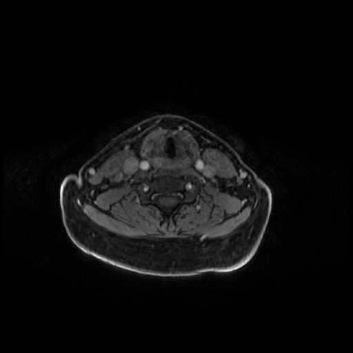 Chronic submandibular sialadenitis (Radiopaedia 61852-69885 Axial T1 C+ fat sat 21).jpg