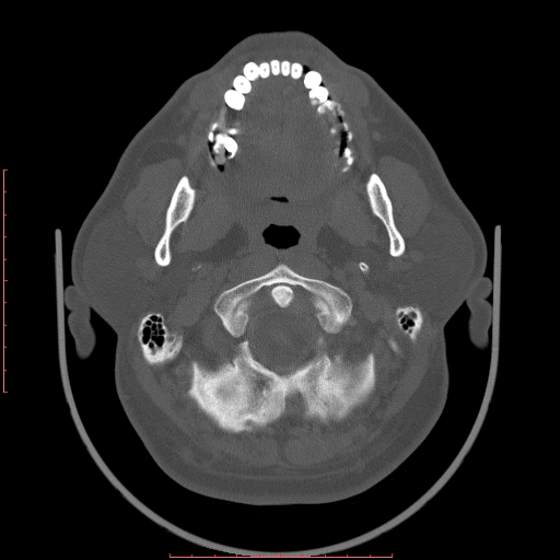 File:Chronic submandibular sialolithiasis (Radiopaedia 69817-79814 Axial bone window 22).jpg