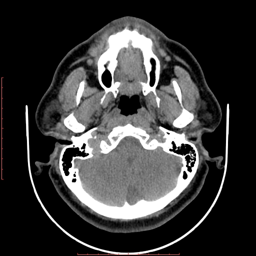 Chronic submandibular sialolithiasis (Radiopaedia 69817-79814 Axial non-contrast 26).jpg