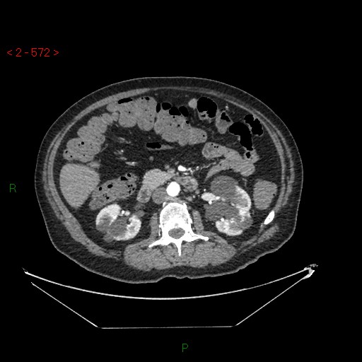 File:Circumaortic left renal vein and doubled left renal arteries (Radiopaedia 52268-58158 A 108).jpg