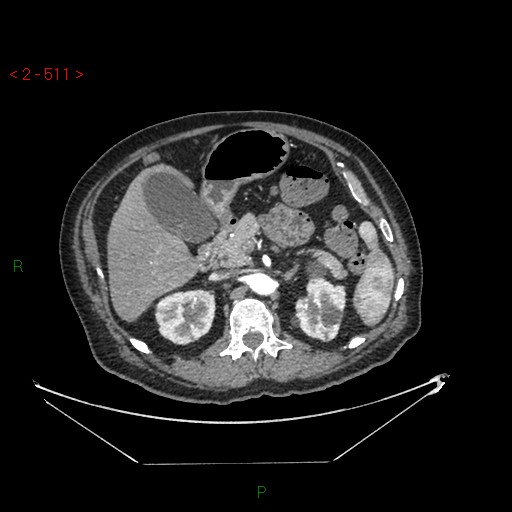 File:Circumaortic left renal vein and doubled left renal arteries (Radiopaedia 52268-58158 A 47).jpg