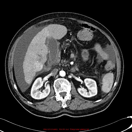 File:Cirrhosis and hepatocellular carcinoma in the setting of hemochromatosis (Radiopaedia 75394-86595 A 38).jpg