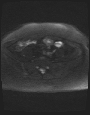 File:Class II Mullerian duct anomaly- unicornuate uterus with rudimentary horn and non-communicating cavity (Radiopaedia 39441-41755 Axial DWI 36).jpg