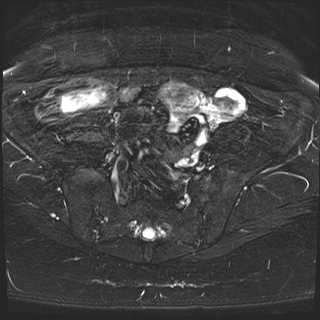 File:Class II Mullerian duct anomaly- unicornuate uterus with rudimentary horn and non-communicating cavity (Radiopaedia 39441-41755 Axial T2 fat sat 7).jpg