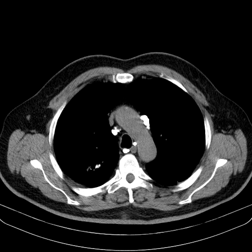 File:Classic complicated silicosis (Radiopaedia 49720-54961 Axial liver window 17).jpg