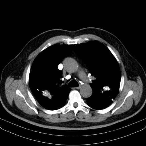 Classic complicated silicosis (Radiopaedia 49720-54961 Axial liver window 21).jpg
