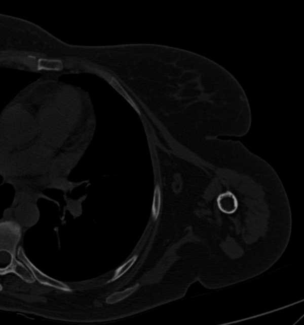 Clear cell chondrosarcoma - humerus (Radiopaedia 63104-71612 Axial bone window 84).jpg