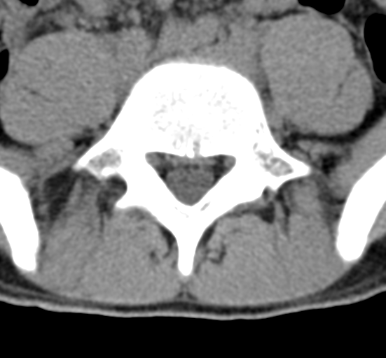 File:Clear cell meningoma - lumbar spine (Radiopaedia 60116-67691 Axial non-contrast 60).png