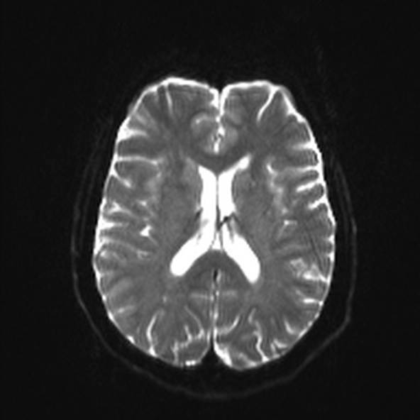 File:Clival meningioma (Radiopaedia 53278-59248 Axial DWI 15).jpg