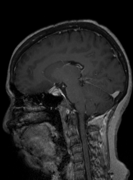 Clival meningioma (Radiopaedia 53278-59248 Sagittal T1 C+ 240).jpg